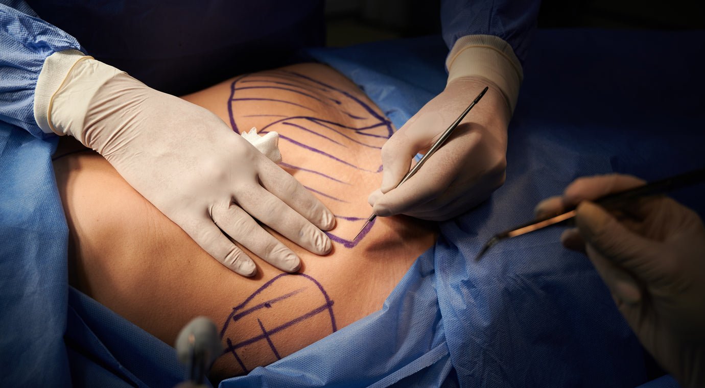 A Comprehensive Guide to Tummy Tuck Surgery - JDCareUSA