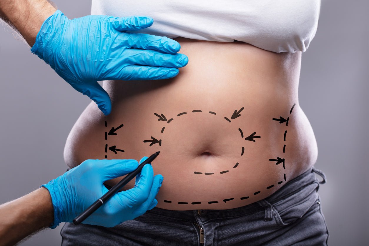 The Comprehensive Guide to Liposuction: Understanding the Procedure, Recovery, and Results - JDCareUSA