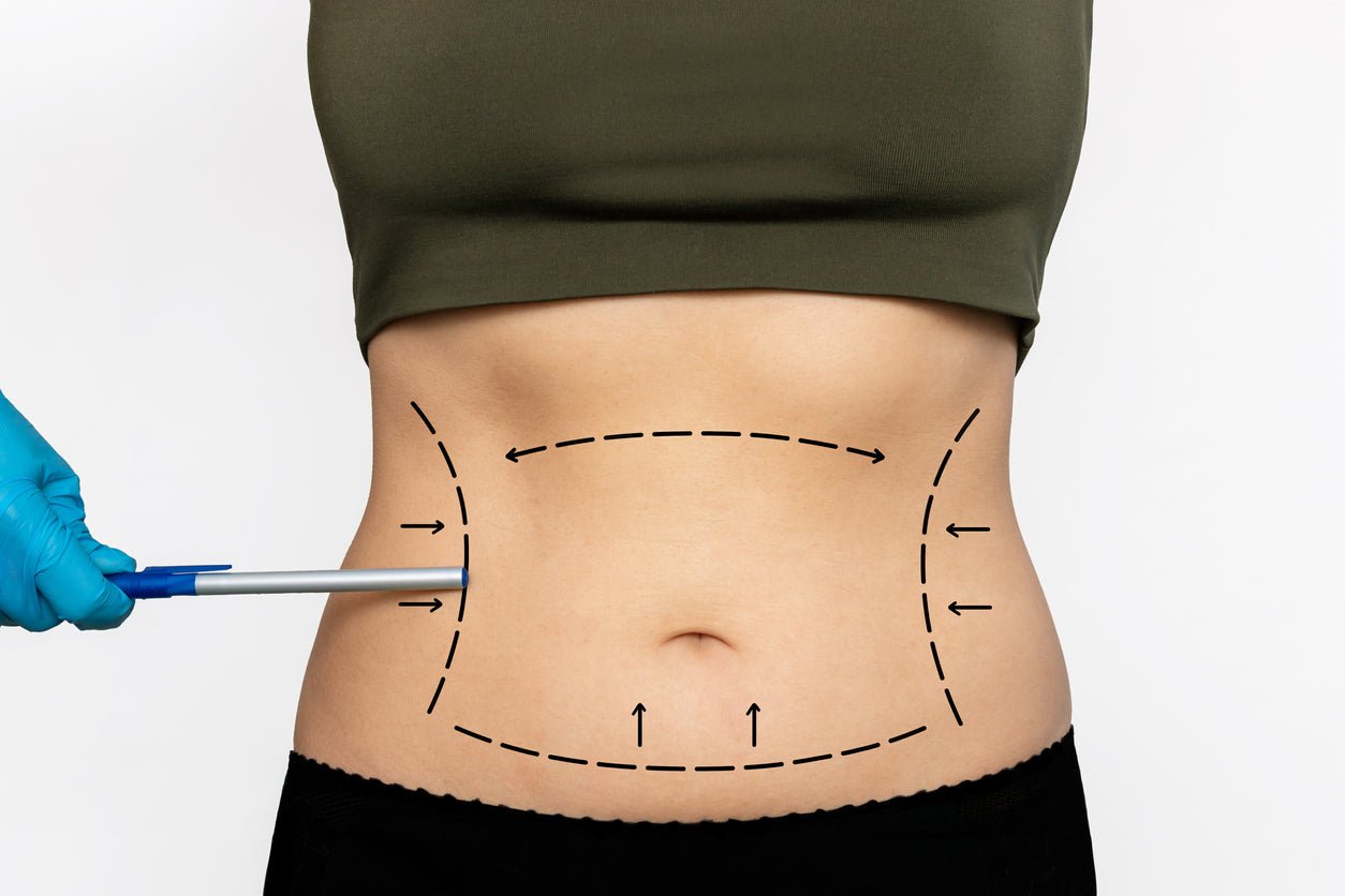 BBL And Liposuction: What Are They And Which Do I Go For? - JDCareUSA