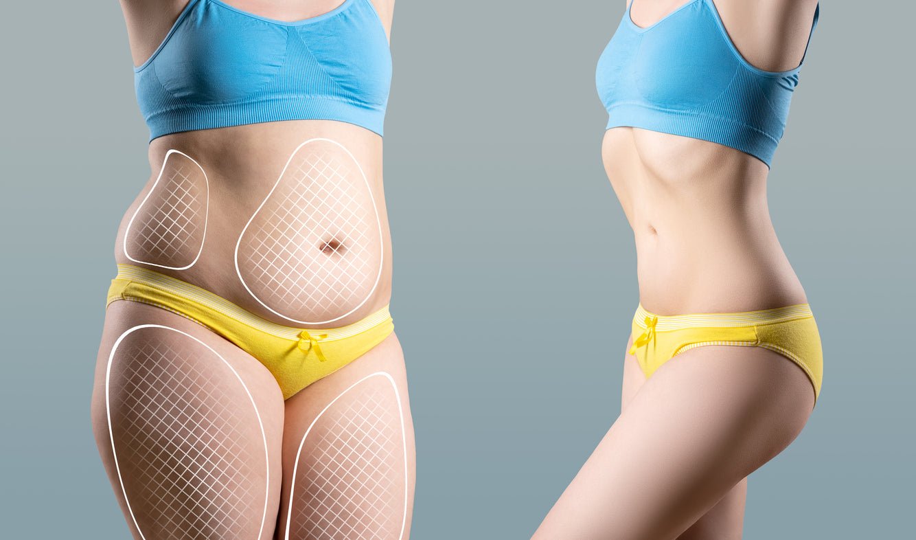 Liposuction Post-Surgery Recovery Timeline and Comfort Measures - JDCareUSA